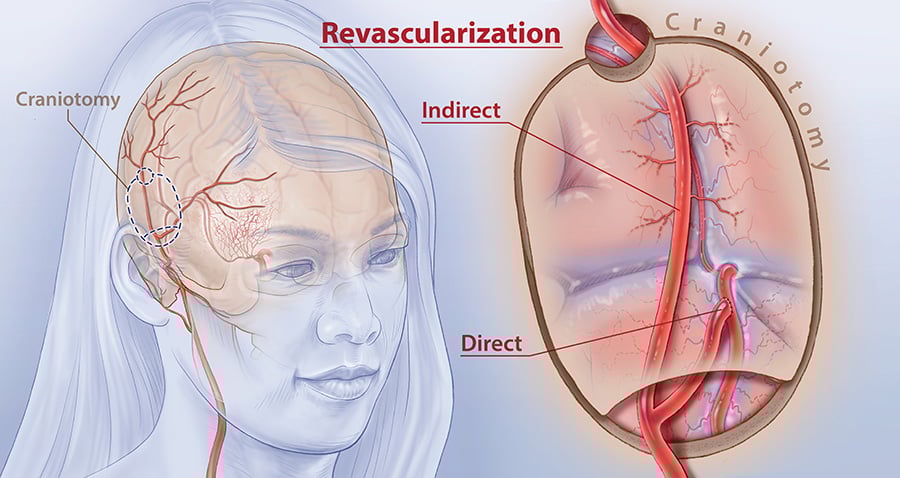 Illustration of brain surgery options for Moyamoya disease, indicating the small incision needed for a craniotomy, as well as diagrams of the two surgical options: direct revascularization, which targets the middle brain artery, and indirect revascularization, in which a blood vessel or blood-rich tissues are laid over the brain's surface. 